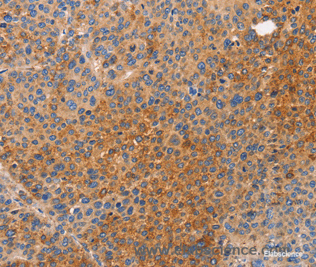 Immunohistochemistry of paraffin-embedded Human liver cancer tissue using NOD1 Polyclonal Antibody at dilution 1:50