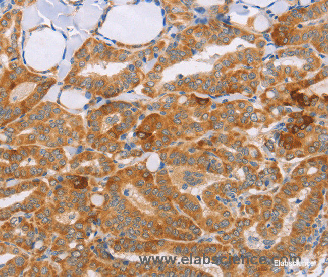 Immunohistochemistry of paraffin-embedded Human thyroid cancer tissue using CARD6 Polyclonal Antibody at dilution 1:60