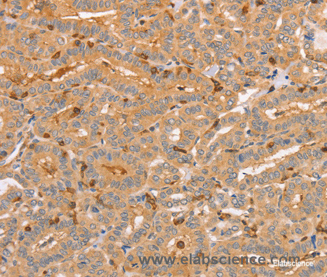 Immunohistochemistry of paraffin-embedded Human thyroid cancer tissue using CCL16 Polyclonal Antibody at dilution 1:60