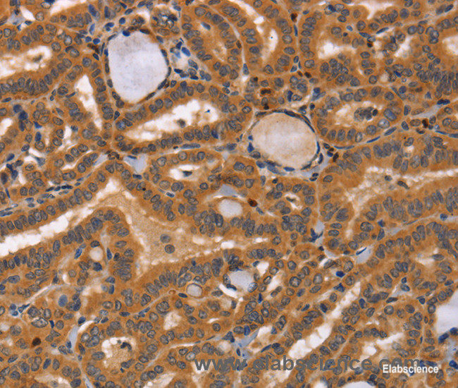 Immunohistochemistry of paraffin-embedded Human thyroid cancer tissue using CCL23 Polyclonal Antibody at dilution 1:50