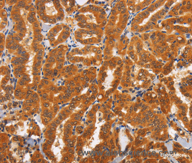 Immunohistochemistry of paraffin-embedded Human thyroid cancer tissue using TNFRSF8 Polyclonal Antibody at dilution 1:60