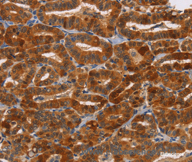 Immunohistochemistry of paraffin-embedded Human thyroid cancer tissue using NCR1 Polyclonal Antibody at dilution 1:30