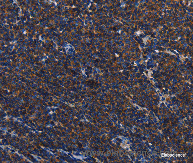 Immunohistochemistry of paraffin-embedded Human Lymphoma tissue using CD45 Polyclonal Antibody at dilution 1:40