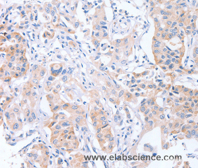 Immunohistochemistry of paraffin-embedded Human lung cancer tissue using CDCA4 Polyclonal Antibody at dilution 1:50