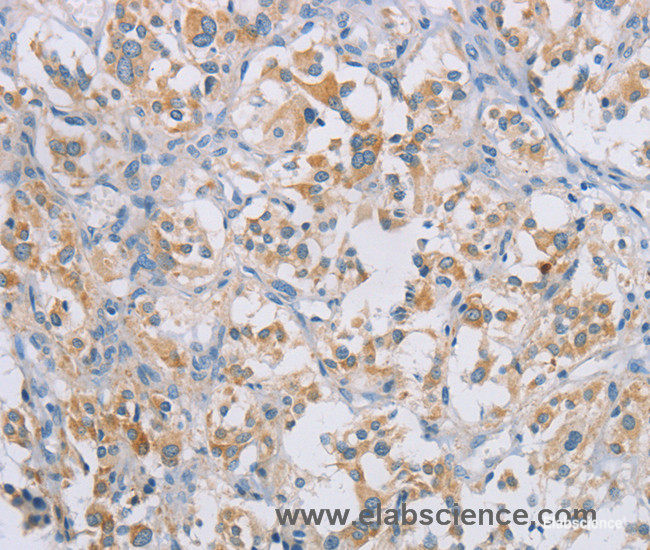 Immunohistochemistry of paraffin-embedded Human thyroid cancer tissue using CERKL Polyclonal Antibody at dilution 1:50