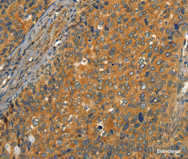 Immunohistochemistry of paraffin-embedded Human cervical cancer tissue using CIB1 Polyclonal Antibody at dilution 1:30