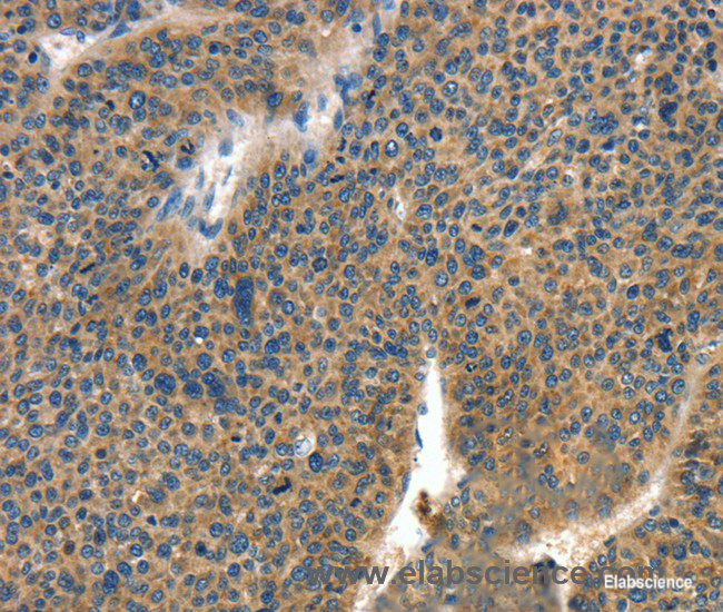 Immunohistochemistry of paraffin-embedded Human liver cancer tissue using COL4A2 Polyclonal Antibody at dilution 1:70