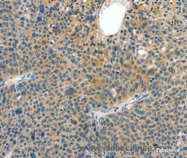 Immunohistochemistry of paraffin-embedded Human liver cancer tissue using CRLF2 Polyclonal Antibody at dilution 1:60