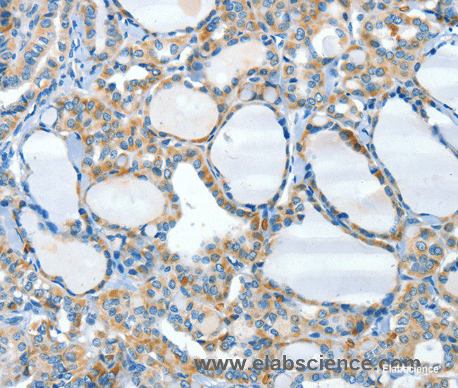 Immunohistochemistry of paraffin-embedded Human thyroid cancer tissue using HID1 Polyclonal Antibody at dilution 1:50