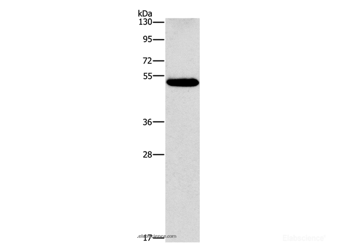 Western Blot analysis of Human lung cancer tissue using CALCRL Polyclonal Antibody at dilution of 1:550