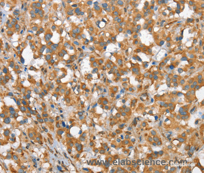 Immunohistochemistry of paraffin-embedded Human thyroid cancer tissue using CSMD1 Polyclonal Antibody at dilution 1:40