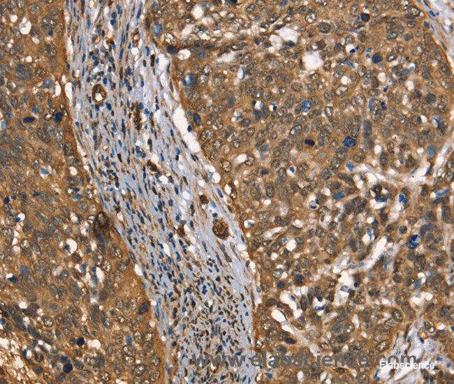 Immunohistochemistry of paraffin-embedded Human cervical cancer tissue using CSTB Polyclonal Antibody at dilution 1:30