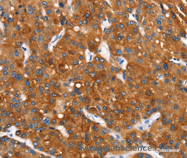Immunohistochemistry of paraffin-embedded Human liver cancer tissue using Cytochrome b Polyclonal Antibody at dilution 1:30