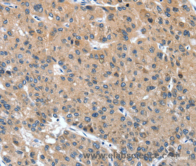 Immunohistochemistry of paraffin-embedded Human liver cancer tissue using DSC1 Polyclonal Antibody at dilution 1:40