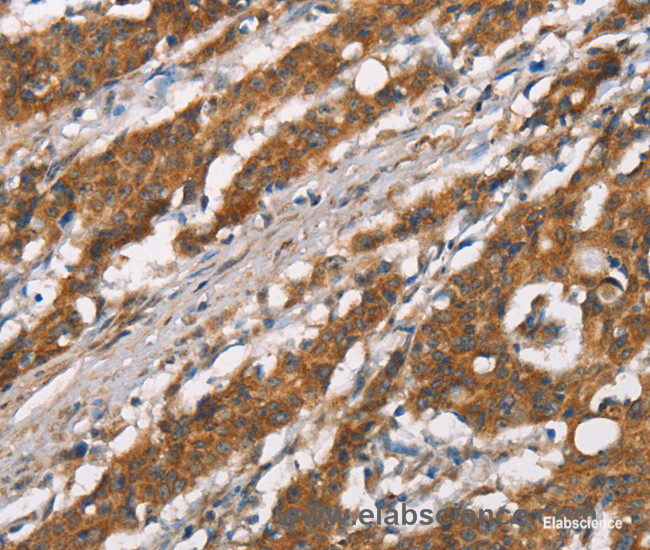 Immunohistochemistry of paraffin-embedded Human gasrtic cancer tissue using DSC2 Polyclonal Antibody at dilution 1:35