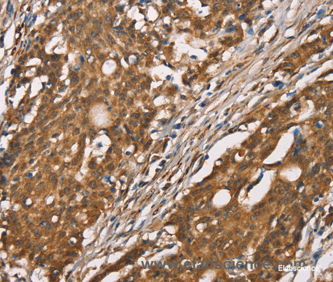 Immunohistochemistry of paraffin-embedded Human gasrtic cancer tissue using DICER1 Polyclonal Antibody at dilution 1:40