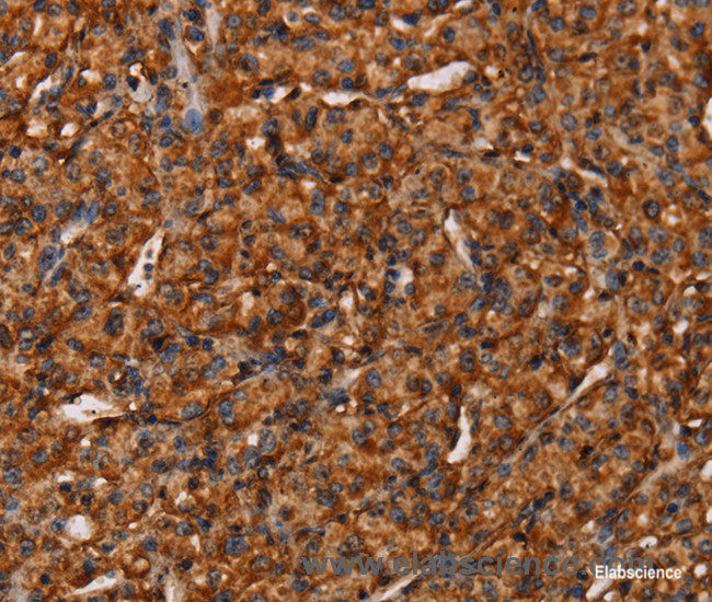Immunohistochemistry of paraffin-embedded Human prostate cancer tissue using COL18A1 Polyclonal Antibody at dilution 1:40