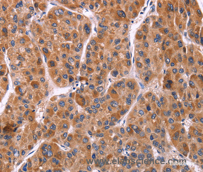 Immunohistochemistry of paraffin-embedded Human liver cancer tissue using Ephrin A5 Polyclonal Antibody at dilution 1:40