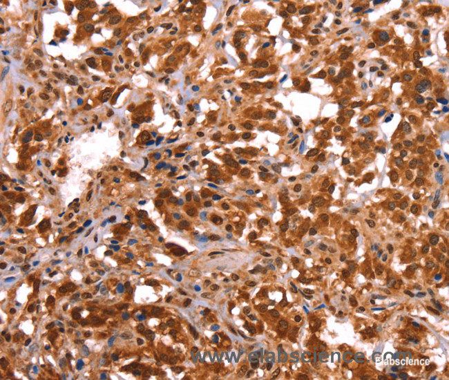 Immunohistochemistry of paraffin-embedded Human thyroid cancer tissue using ESRRB Polyclonal Antibody at dilution 1:40