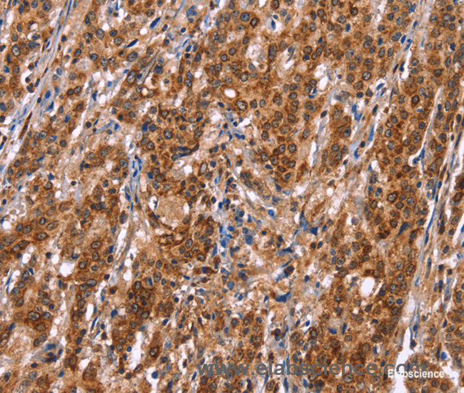 Immunohistochemistry of paraffin-embedded Human gasrtic cancer tissue using TDP2 Polyclonal Antibody at dilution 1:40