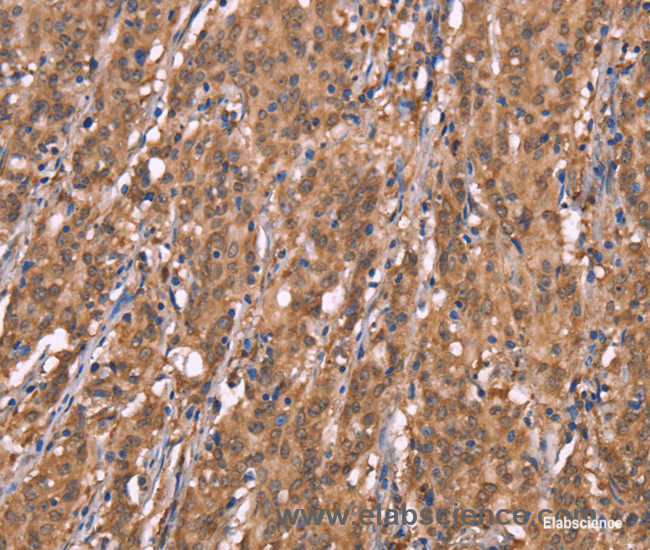 Immunohistochemistry of paraffin-embedded Human gasrtic cancer tissue using FBXO31 Polyclonal Antibody at dilution 1:40