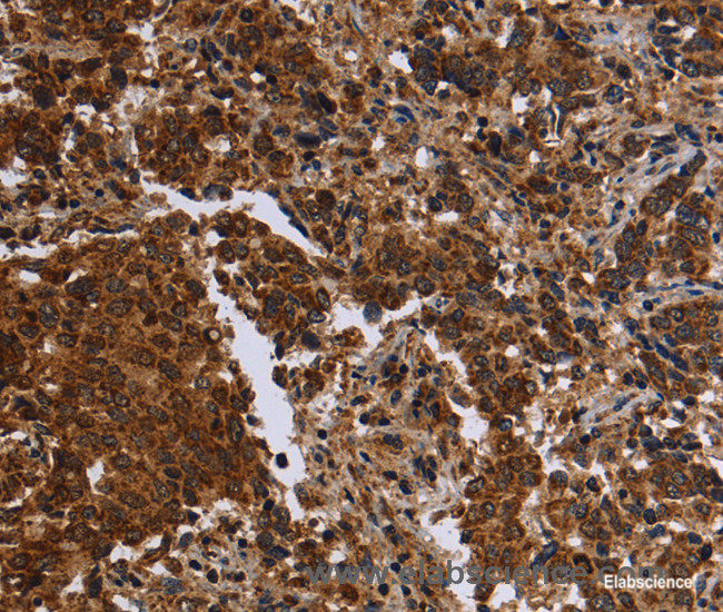 Immunohistochemistry of paraffin-embedded Human liver cancer tissue using FMN2 Polyclonal Antibody at dilution 1:30
