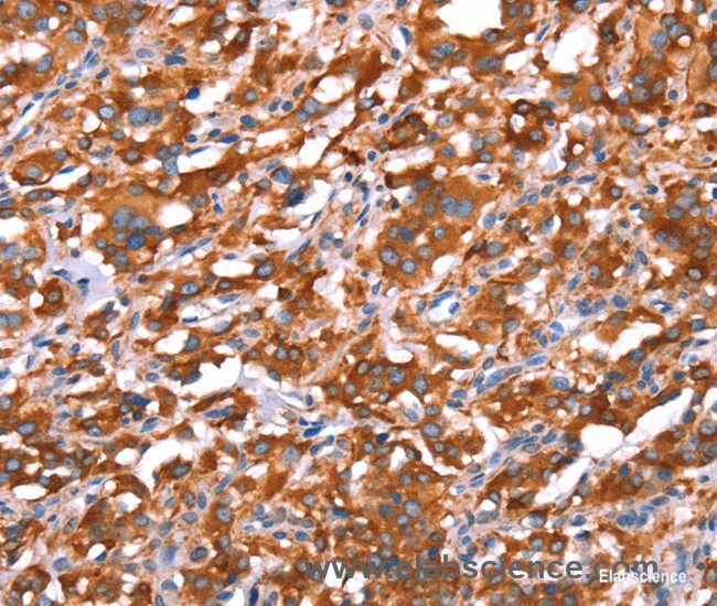 Immunohistochemistry of paraffin-embedded Human thyroid cancer tissue using GAS8 Polyclonal Antibody at dilution 1:40