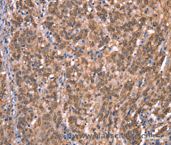Immunohistochemistry of paraffin-embedded Human gasrtic cancer tissue using GCSAM Polyclonal Antibody at dilution 1:40