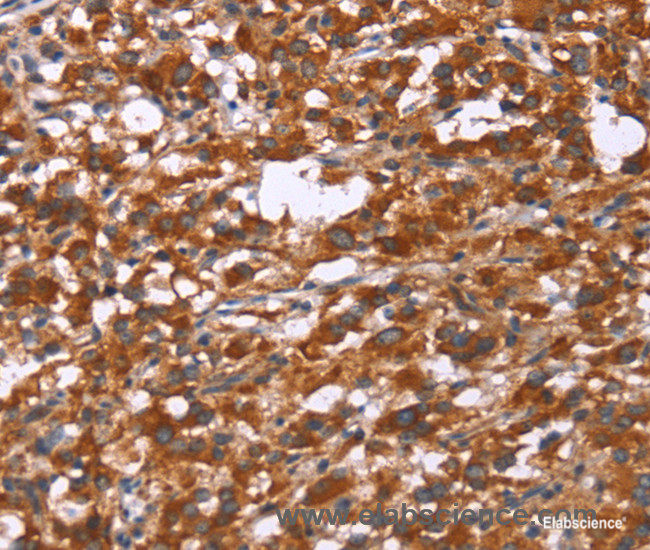Immunohistochemistry of paraffin-embedded Human thyroid cancer tissue using GPHN Polyclonal Antibody at dilution 1:30