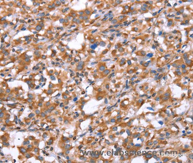 Immunohistochemistry of paraffin-embedded Human thyroid cancer tissue using GPC6 Polyclonal Antibody at dilution 1:40