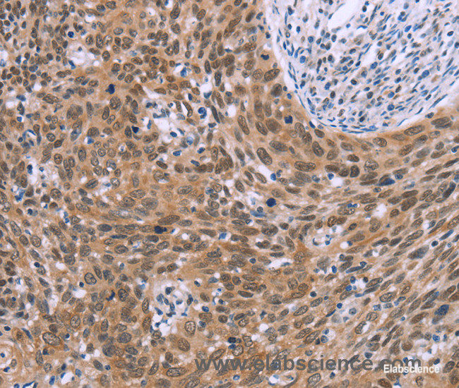 Immunohistochemistry of paraffin-embedded Human cervical cancer tissue using GLYR1 Polyclonal Antibody at dilution 1:30