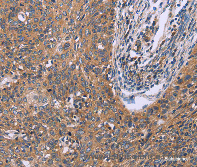 Immunohistochemistry of paraffin-embedded Human cervical cancer tissue using IL3RB Polyclonal Antibody at dilution 1:40