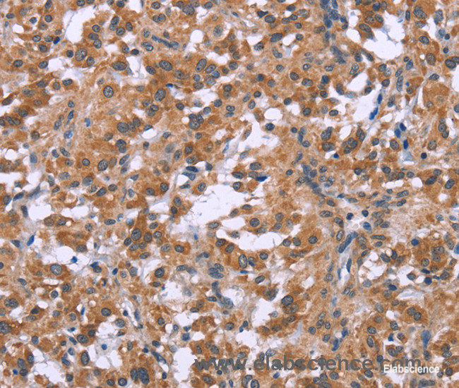 Immunohistochemistry of paraffin-embedded Human thyroid cancer tissue using GNPAT Polyclonal Antibody at dilution 1:40