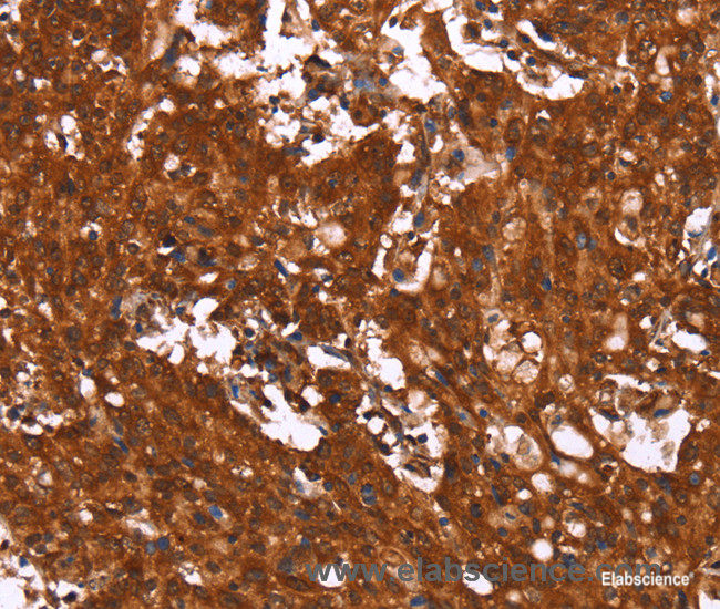 Immunohistochemistry of paraffin-embedded Human gasrtic cancer tissue using HCAR2 Polyclonal Antibody at dilution 1:40