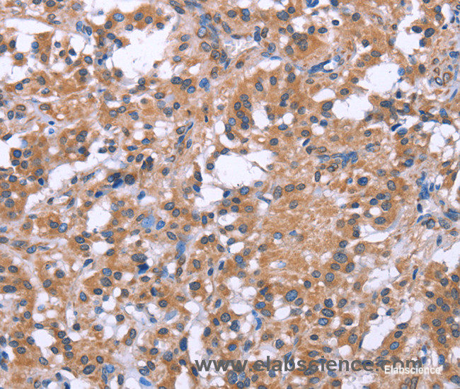 Immunohistochemistry of paraffin-embedded Human thyroid cancer tissue using GPR172B Polyclonal Antibody at dilution 1:40