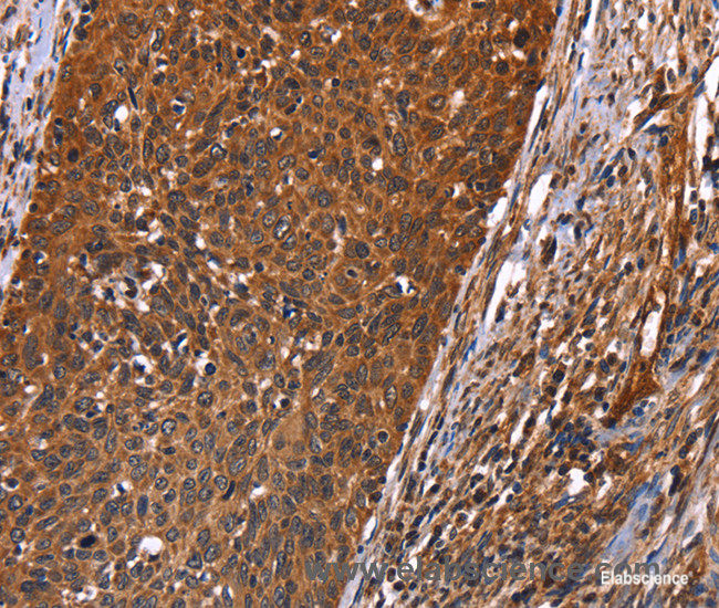 Immunohistochemistry of paraffin-embedded Human cervical cancer tissue using GUK1 Polyclonal Antibody at dilution 1:40