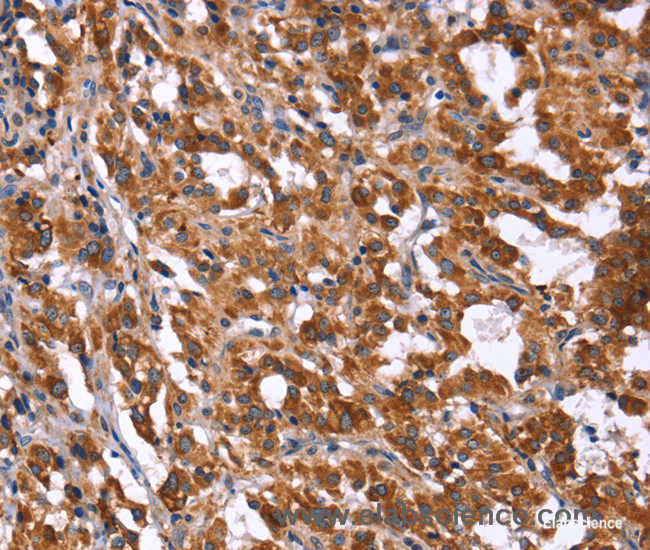 Immunohistochemistry of paraffin-embedded Human thyroid cancer tissue using HACE1 Polyclonal Antibody at dilution 1:40