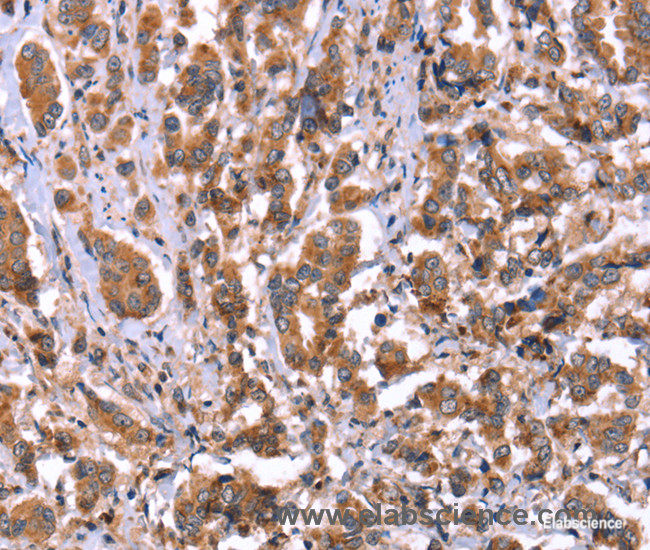 Immunohistochemistry of paraffin-embedded Human breast cancer tissue using HRG Polyclonal Antibody at dilution 1:50