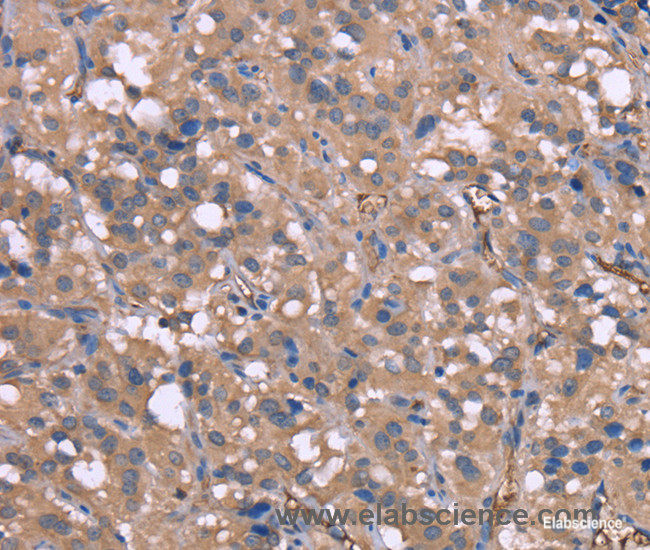 Immunohistochemistry of paraffin-embedded Human thyroid cancer tissue using HP Polyclonal Antibody at dilution 1:50