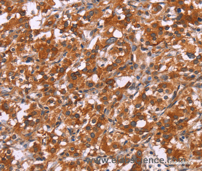 Immunohistochemistry of paraffin-embedded Human thyroid cancer tissue using HSPB6 Polyclonal Antibody at dilution 1:30