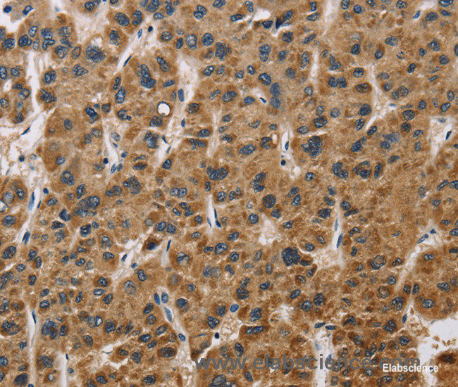 Immunohistochemistry of paraffin-embedded Human liver cancer tissue using IL19 Polyclonal Antibody at dilution 1:40