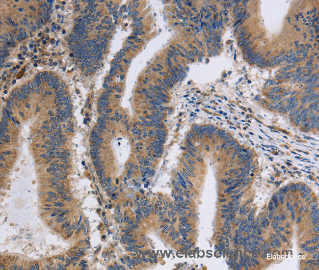 Immunohistochemistry of paraffin-embedded Human colon cancer tissue using ITPR1 Polyclonal Antibody at dilution 1:40