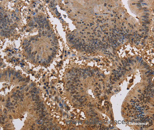 Immunohistochemistry of paraffin-embedded Human colon cancer tissue using JAG2 Polyclonal Antibody at dilution 1:30
