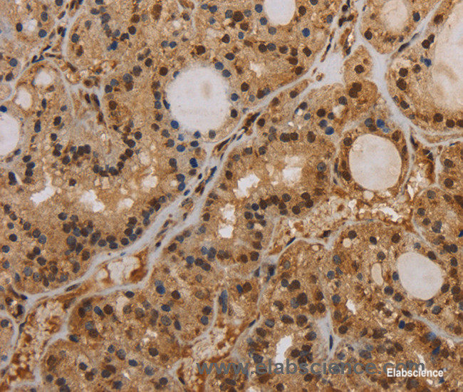 Immunohistochemistry of paraffin-embedded Human thyroid cancer tissue using KCNN4 Polyclonal Antibody at dilution 1:50