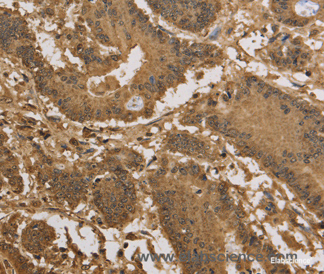 Immunohistochemistry of paraffin-embedded Human colon cancer tissue using KDM5B Polyclonal Antibody at dilution 1:40