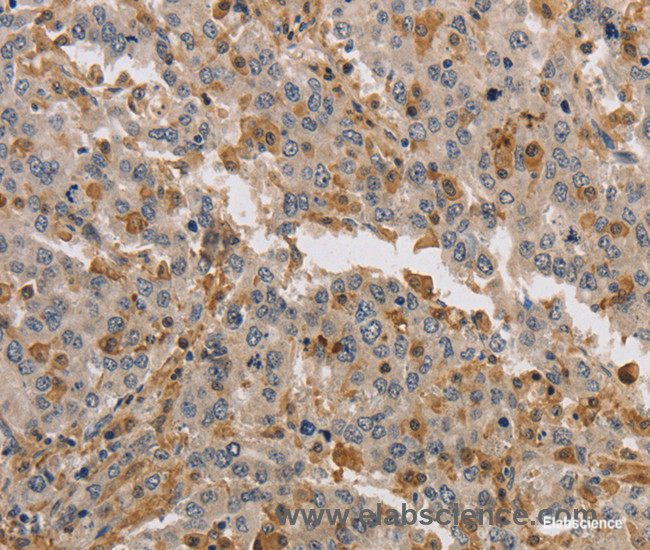 Immunohistochemistry of paraffin-embedded Human liver cancer tissue using KIF17 Polyclonal Antibody at dilution 1:40