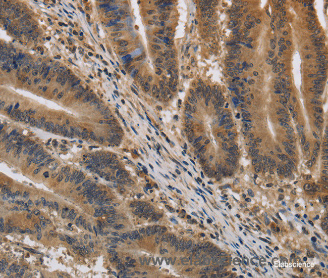 Immunohistochemistry of paraffin-embedded Human colon cancer tissue using KIF22 Polyclonal Antibody at dilution 1:40