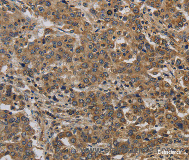 Immunohistochemistry of paraffin-embedded Human liver cancer tissue using KIF4A Polyclonal Antibody at dilution 1:40