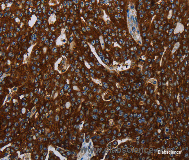 Immunohistochemistry of paraffin-embedded Human ovarian cancer tissue using KISS1R Polyclonal Antibody at dilution 1:30
