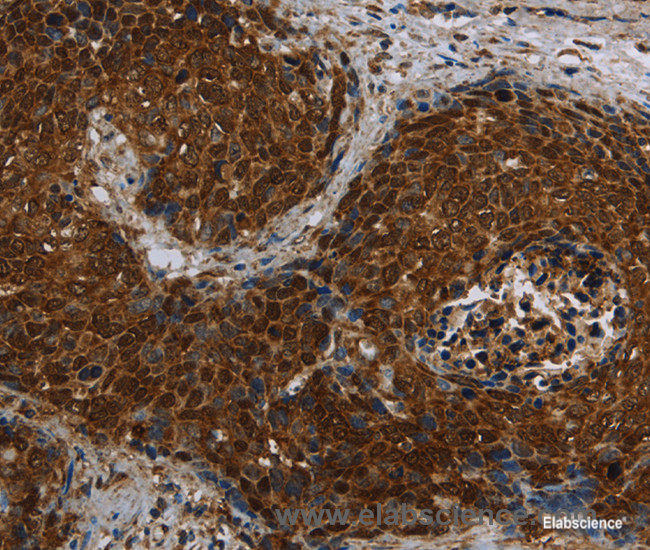 Immunohistochemistry of paraffin-embedded Human cervical cancer tissue using CERS5 Polyclonal Antibody at dilution 1:40